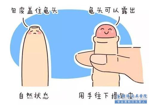 马鞍山男科：包皮过长是会遗传的吗？