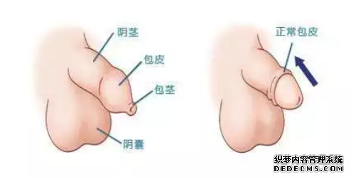 马鞍山当涂县包皮过长什么症状