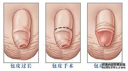 马鞍山和县20岁以后做包皮还来得及吗